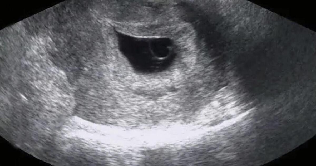 Плод 5 6 недель. Снимок УЗИ на 6 неделе беременности. Беременность 7 недель фото эмбриона на УЗИ. УЗИ беременности 6-7 недель плодное яйцо. УЗИ 6 недель беременности фото.