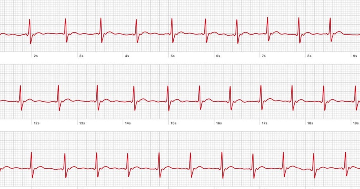 En que consiste un electrocardiograma