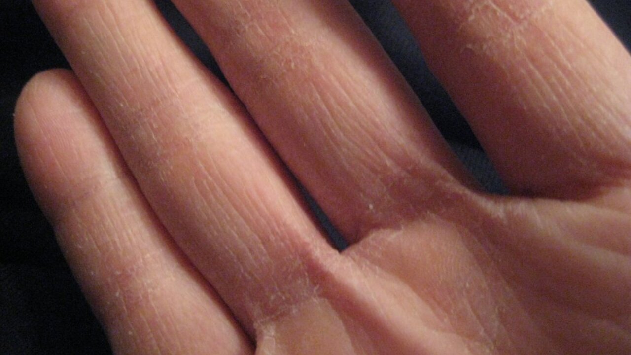 грибок между пальцами фото